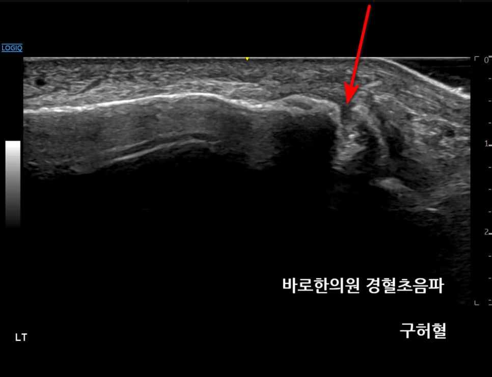 발목 바깥쪽 뼈의 초음파 사진으로, 뼈 표면의 불연속성이 화살표로 표시되어 있습니다 — 초음파 정밀 진단 | 서울 바로한의원 초음파 약침·도침·침도