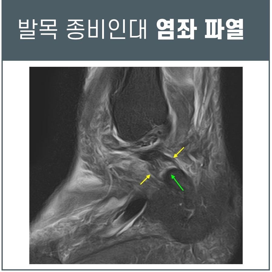 발목 종비인대 파열 부위를 화살표로 표시한 MRI 영상 — 서울 바로한의원 초음파 약침·도침