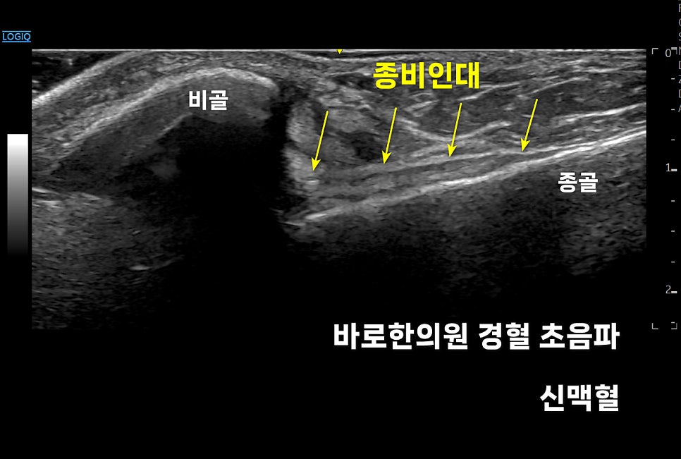 발목 초음파 사진으로, 비골과 종골 사이에 있는 종비인대를 노란색 화살표로 표시한 모습 — 초음파 정밀 진단 | 서울 바로한의원 초음파 약침·도침·침도