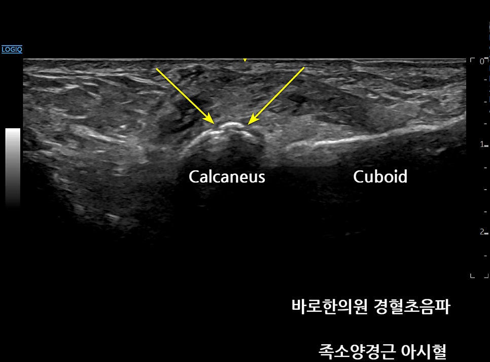 발목 부위의 종골과 입방골을 보여주는 초음파 사진 — 초음파 정밀 진단 | 서울 바로한의원 초음파 약침·도침·침도