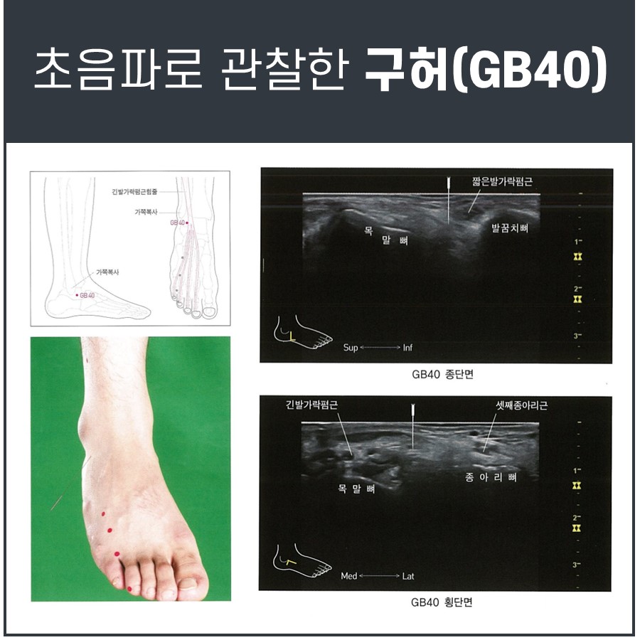발목 부위의 구허(GB40) 혈자리 위치를 보여주는 그림과 초음파 영상 — 초음파 정밀 진단 | 서울 바로한의원 초음파 약침·도침·침도
