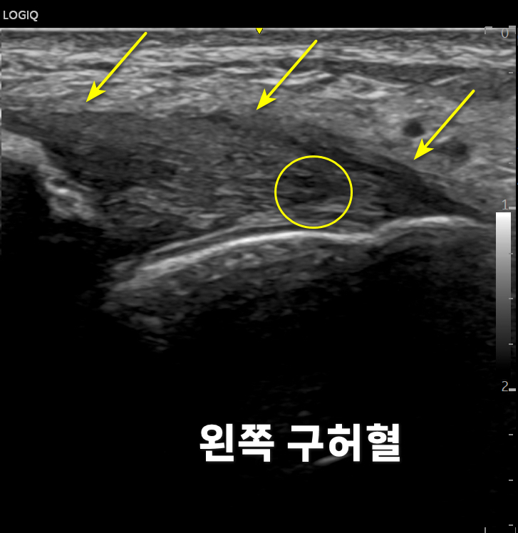 노란색 화살표와 원으로 특정 부위가 표시된 발목 부위 초음파 사진과 '왼쪽 구허혈'이라는 글자 — 초음파 정밀 진단 | 서울 바로한의원 초음파 약침·도침·침도