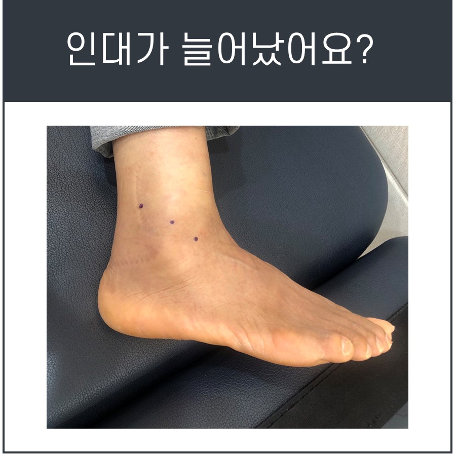 발목 골절, 꼭 수술해야 하나요? [비골 골절의 Weber 분류]