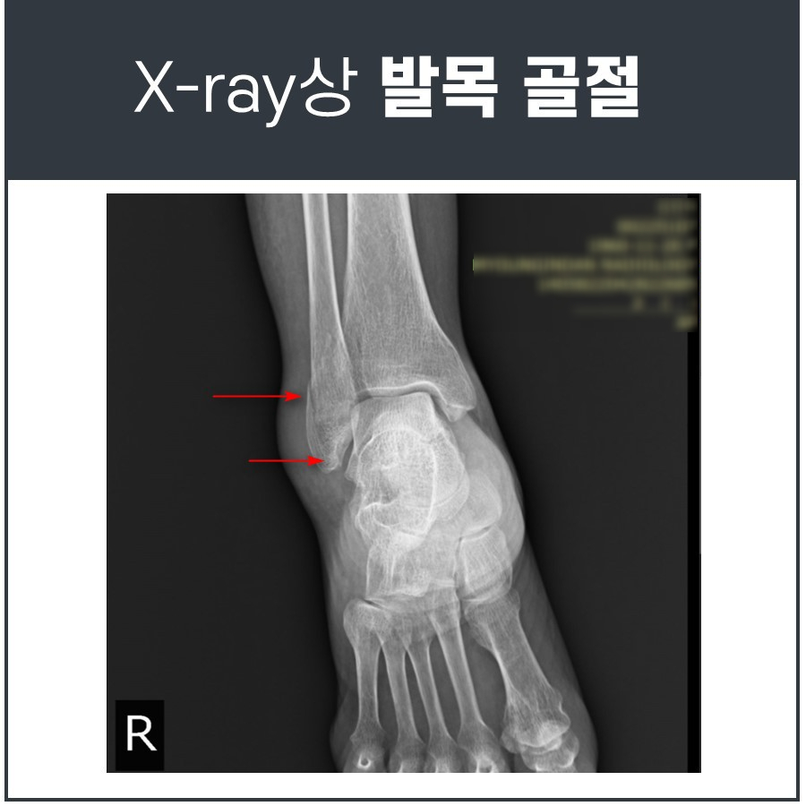 오른쪽 발목 비골 골절 부위를 빨간 화살표로 표시한 X-ray 사진 — 서울 바로한의원 초음파 약침·도침