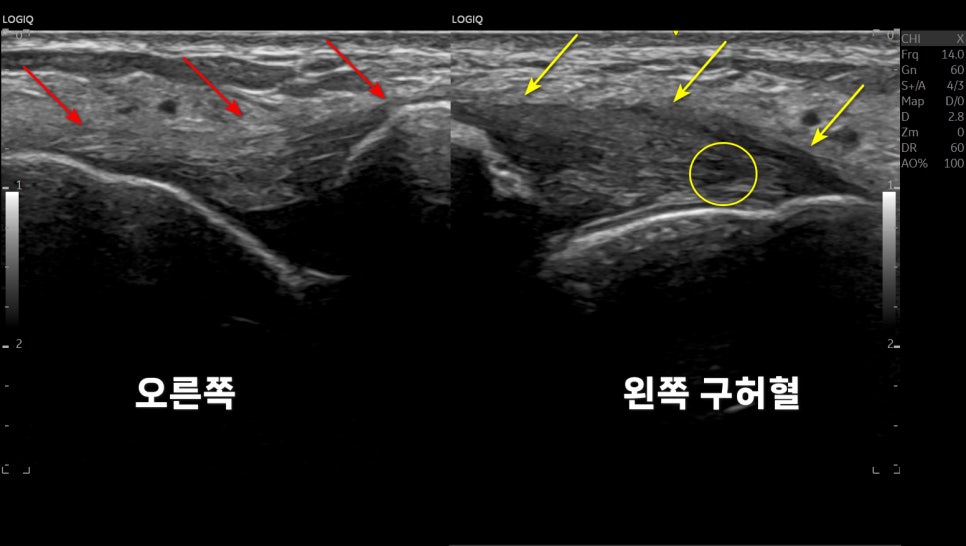오른쪽과 왼쪽 구허혈 부위를 보여주는 초음파 이미지로, 화살표와 원으로 특정 영역이 강조되어 있다 — 초음파 정밀 진단 | 서울 바로한의원 초음파 약침·도침·침도
