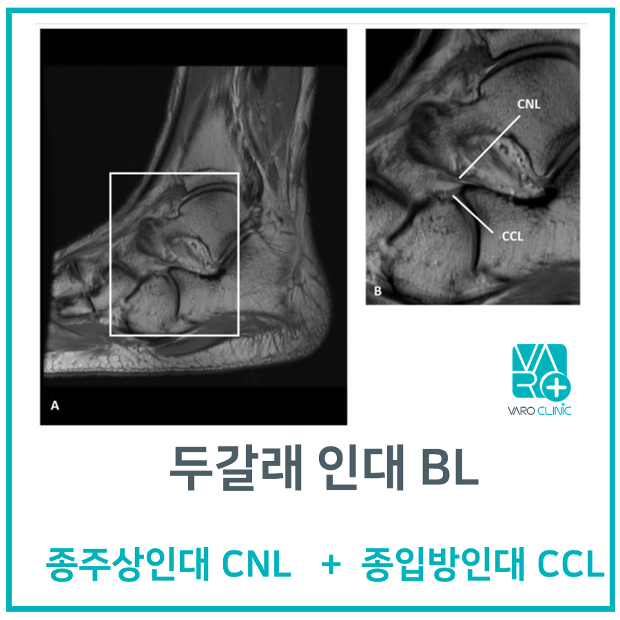 발목 MRI 영상에서 두갈래 인대와 종주상인대, 종입방인대가 표시되어 있다 — 서울 바로한의원 초음파 약침·도침