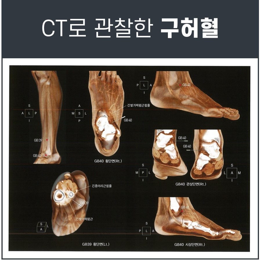 발목과 발의 뼈와 힘줄, 혈자리를 다양한 각도에서 보여주는 CT 스캔 이미지 — 서울 바로한의원 초음파 약침·도침
