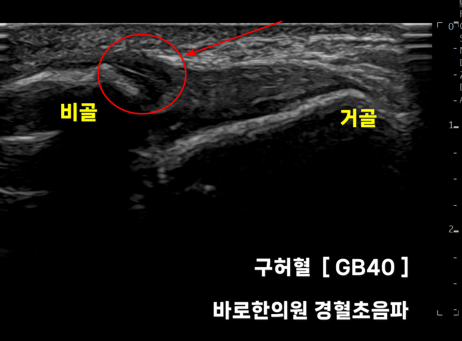 발목 인대 부위의 초음파 사진으로, 비골과 거골 사이의 인대와 구허혈(GB40)이 표시되어 있습니다 — 초음파 정밀 진단 | 서울 바로한의원 초음파 약침·도침·침도