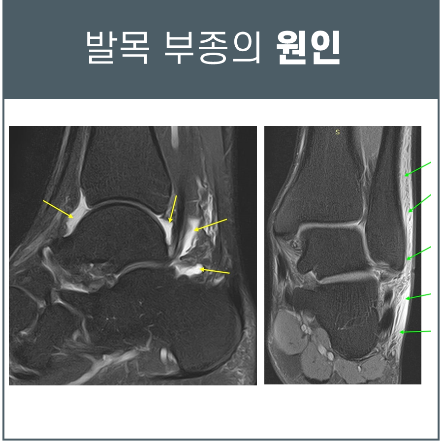 발목의 두 가지 MRI 영상으로, 노란색 화살표는 인대 손상 부위를, 초록색 화살표는 부종 부위를 나타낸다 — 초음파 약침·도침 임상 논문 | 서울 바로한의원