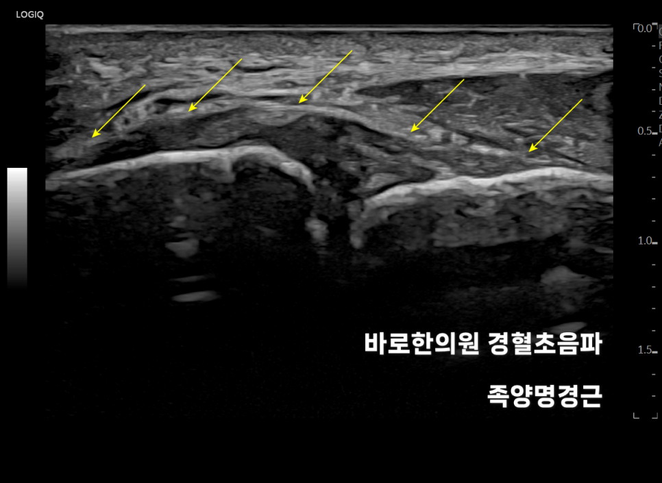 발목 부위의 연부 조직을 보여주는 초음파 영상으로, 노란색 화살표가 특정 인대 또는 건 구조를 가리키고 있습니다 — 초음파 정밀 진단 | 서울 바로한의원 초음파 약침·도침·침도