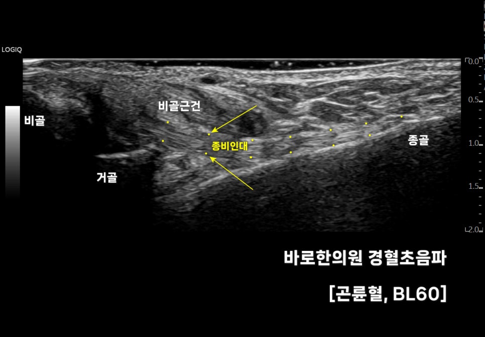 발목 부위의 비골, 거골, 종골, 비골근건, 종비인대를 표시한 초음파 이미지 — 초음파 정밀 진단 | 서울 바로한의원 초음파 약침·도침·침도