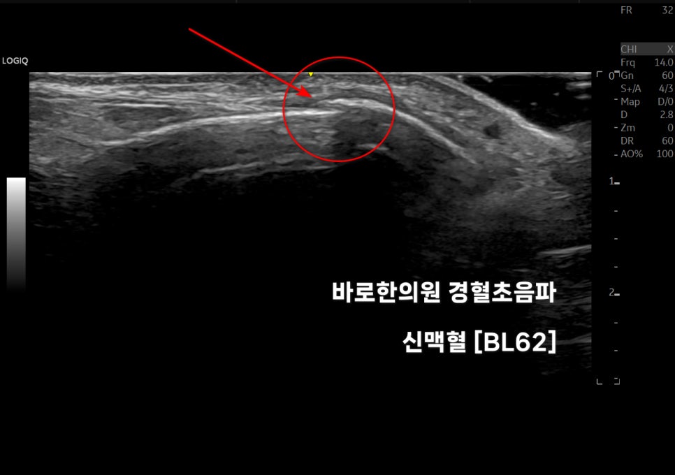 발목 신맥혈(BL62) 경혈 초음파 사진으로, 붉은 원과 화살표가 특정 부위를 표시하고 있습니다 — 초음파 정밀 진단 | 서울 바로한의원 초음파 약침·도침·침도