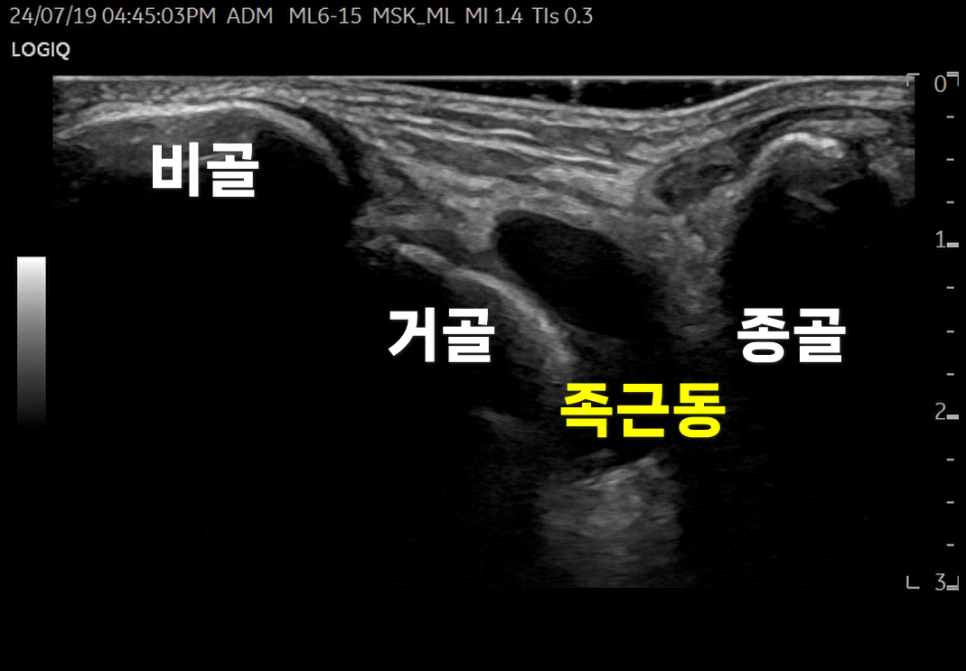 발목 초음파 사진으로 비골, 거골, 종골, 족근동이 표시되어 있다 — 초음파 정밀 진단 | 서울 바로한의원 초음파 약침·도침·침도