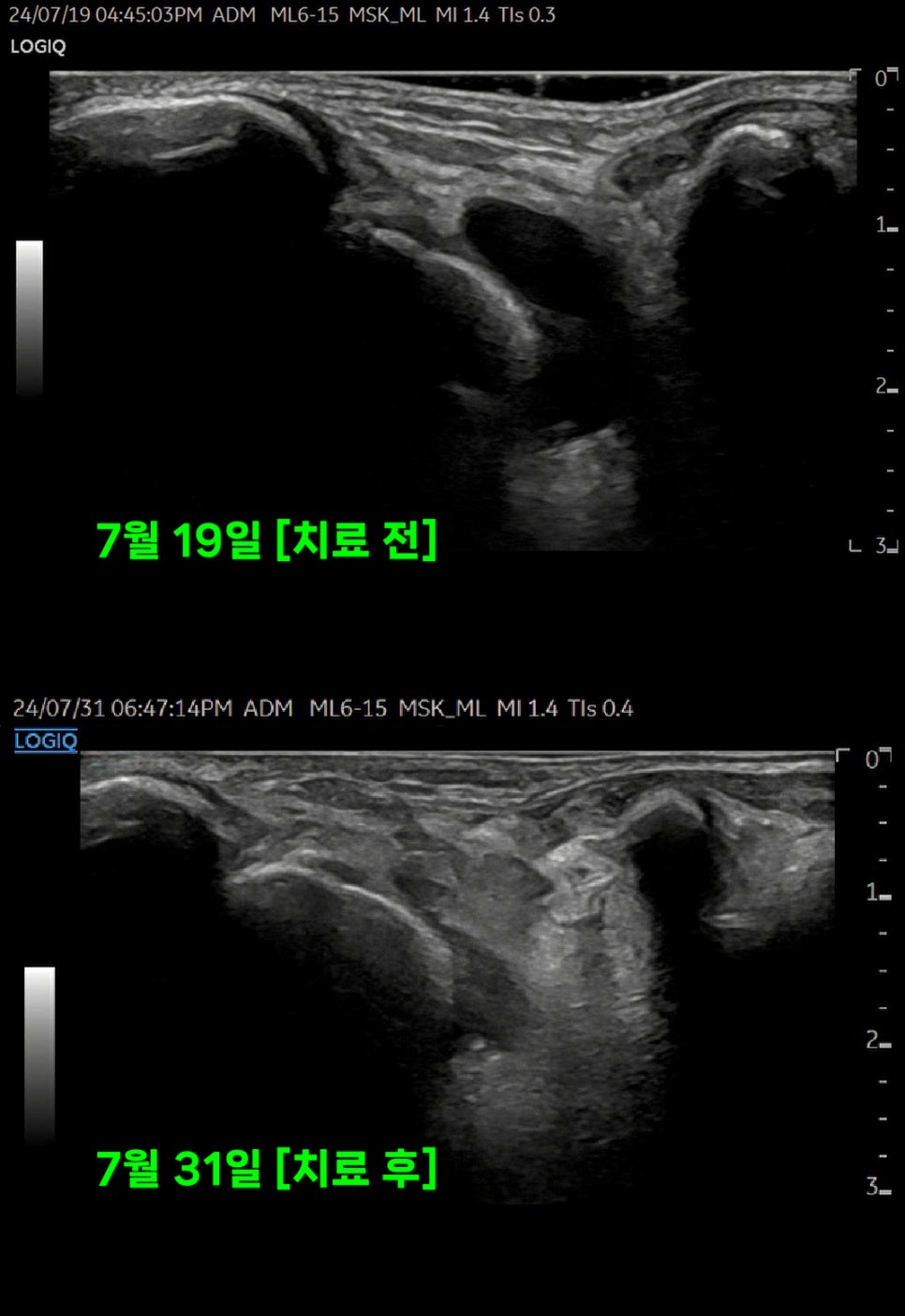 발목 족근동 초음파 치료 전후 비교 사진 — 초음파 정밀 진단 | 서울 바로한의원 초음파 약침·도침·침도