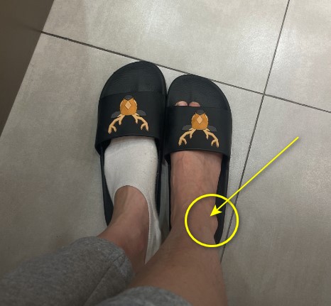 검은색 슬리퍼를 신은 발 두 개가 보이며, 오른쪽 발의 바깥쪽 복숭아뼈 부위가 노란색 화살표와 원으로 표시되어 있다 — 서울 바로한의원 초음파 약침·도침