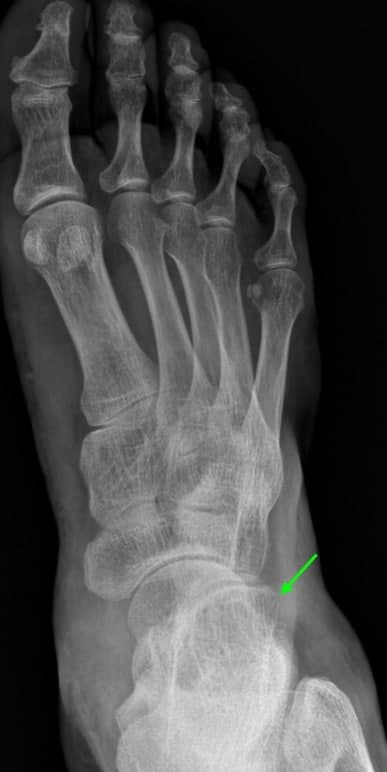 발목 X-ray 사진에서 외측 복사뼈 부근에 녹색 화살표가 가리키는 작은 뼈 조각이 보인다 — 서울 바로한의원 초음파 약침·도침