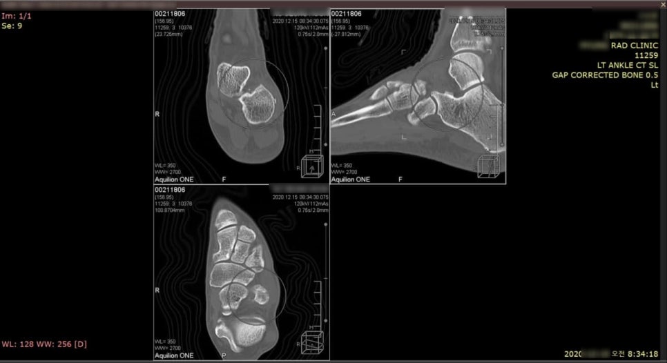 왼쪽 발목의 뼈 구조를 보여주는 여러 각도의 CT 스캔 이미지 — 서울 바로한의원 초음파 약침·도침