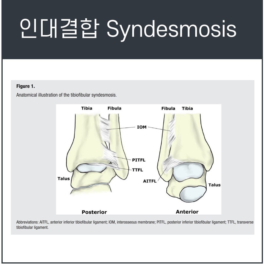 발목 인대결합의 해부학적 구조를 후면과 전면에서 보여주는 그림으로, 경골, 비골, 거골 및 관련 인대들이 표시되어 있습니다 — 서울 바로한의원 초음파 약침·도침
