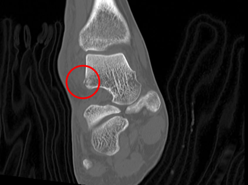 발목 CT 사진에서 거골 앞쪽의 작은 골절편이 빨간색 원으로 표시되어 있다 — 서울 바로한의원 초음파 약침·도침