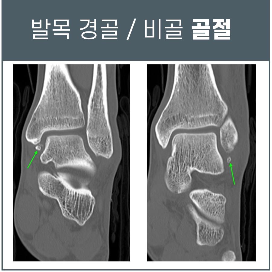 발목 경골과 비골 주변에 작은 골절 조각이 보이는 CT 영상 두 장 — 서울 바로한의원 초음파 약침·도침