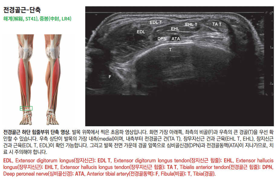 발목 앞쪽 근육 해부학 그림과 함께 비골, 경골, 전경골근 건, 장무지신근 건, 장지신근 건, 심비골신경, 전경골동맥이 표시된 발목 초음파 영상 — 초음파 정밀 진단 | 서울 바로한의원 초음파 약침·도침·침도