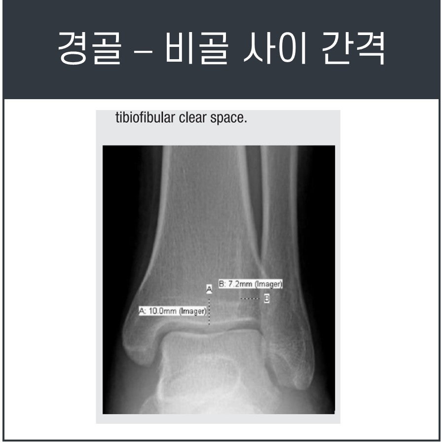 발목 엑스레이 사진에서 경골과 비골 사이 간격을 측정한 모습 — 서울 바로한의원 초음파 약침·도침