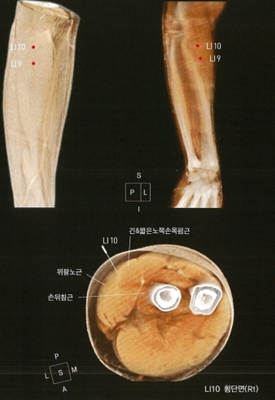 팔과 전완의 LI9, LI10 경혈 위치를 표시한 의료 영상과 해당 부위의 근육 및 뼈 횡단면 영상 — 초음파 정밀 진단 | 서울 바로한의원 초음파 약침·도침·침도
