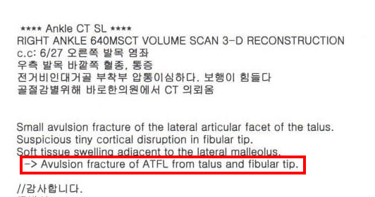 발목 CT 검사 결과, 전거비인대 견열 골절 소견이 기록된 문서 — 서울 바로한의원 초음파 약침·도침