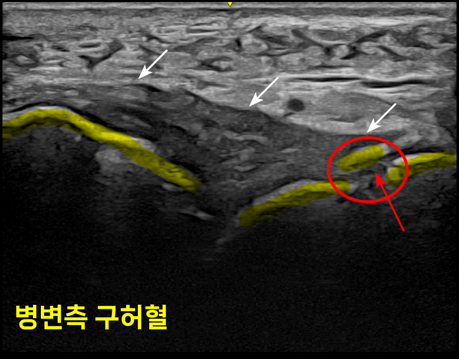 발목 앞쪽 통증 부위의 초음파 영상으로, '병변측 구허혈'이라는 글자와 함께 화살표와 빨간색 원으로 표시된 병변 부위, 그리고 노란색으로 강조된 구조물이 보인다 — 초음파 정밀 진단 | 서울 바로한의원 초음파 약침·도침·침도