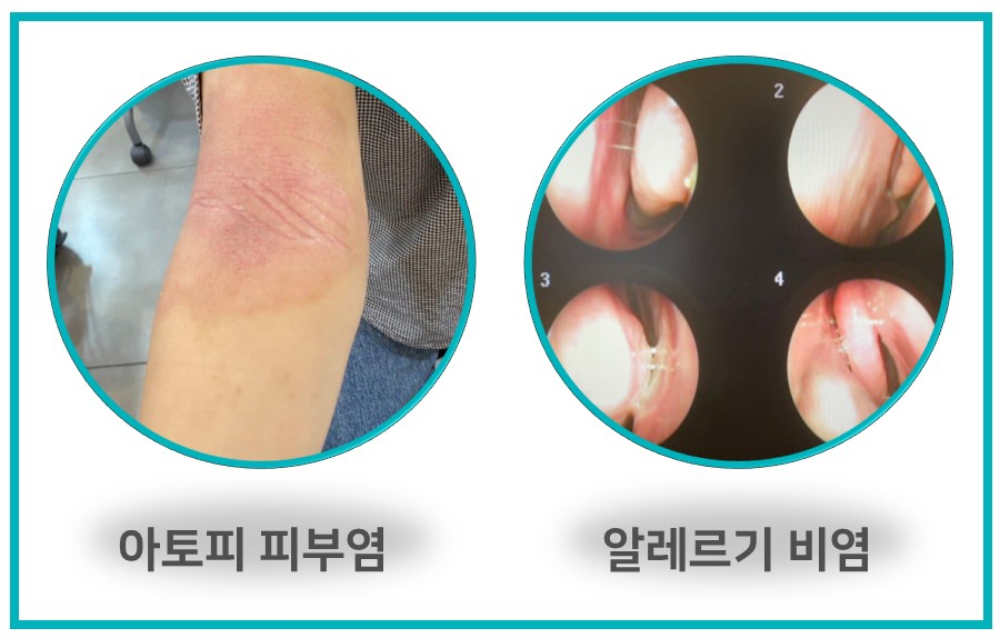 팔에 나타난 아토피 피부염 증상과 코 내부를 촬영한 내시경 사진 4장 — 서울 바로한의원 초음파 약침·도침