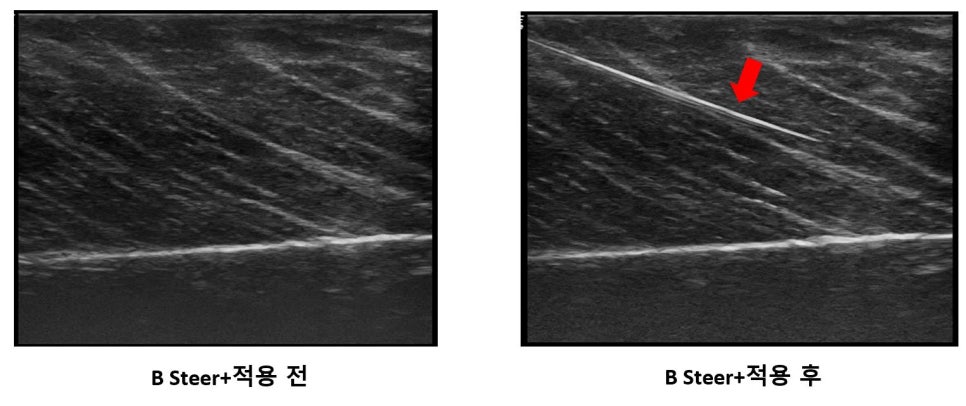 B Steer+ 적용 전후 초음파 영상 비교. 적용 후 영상에서 조직 내 침이 붉은 화살표와 함께 보인다 — 초음파 유도하 약침 시술 | 서울 바로한의원