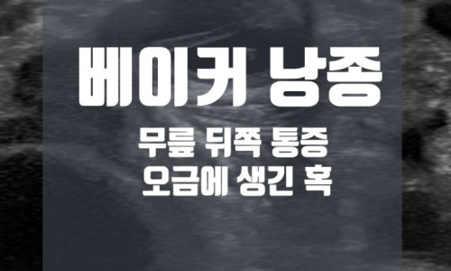베이커 낭종, 무릎 뒤쪽 통증, 오금에 생긴 혹이라는 문구가 있는 초음파 이미지 — 초음파 정밀 진단 | 서울 바로한의원 초음파 약침·도침·침도