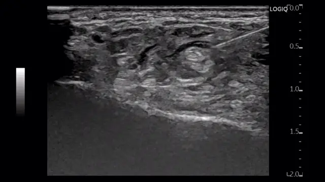 발바닥 부위의 연부 조직과 뼈 경계를 나타내는 흑백 초음파 이미지 — 초음파 정밀 진단 | 서울 바로한의원 초음파 약침·도침·침도