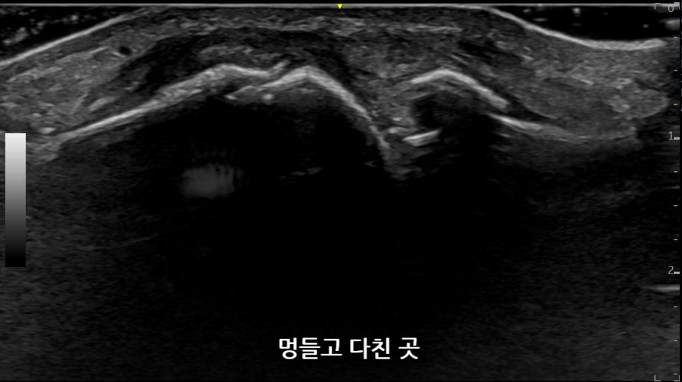 엄지발가락 멍들고 다친 부위의 초음파 사진 — 초음파 정밀 진단 | 서울 바로한의원 초음파 약침·도침·침도