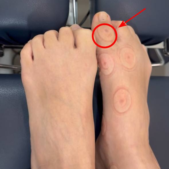 위에서 내려다본 두 발 중 오른쪽 발 엄지발가락과 발등에 둥근 부항 자국이 여러 개 보이며, 엄지발가락의 자국은 빨간 원과 화살표로 표시되어 있다 — 서울 바로한의원 초음파 약침·도침