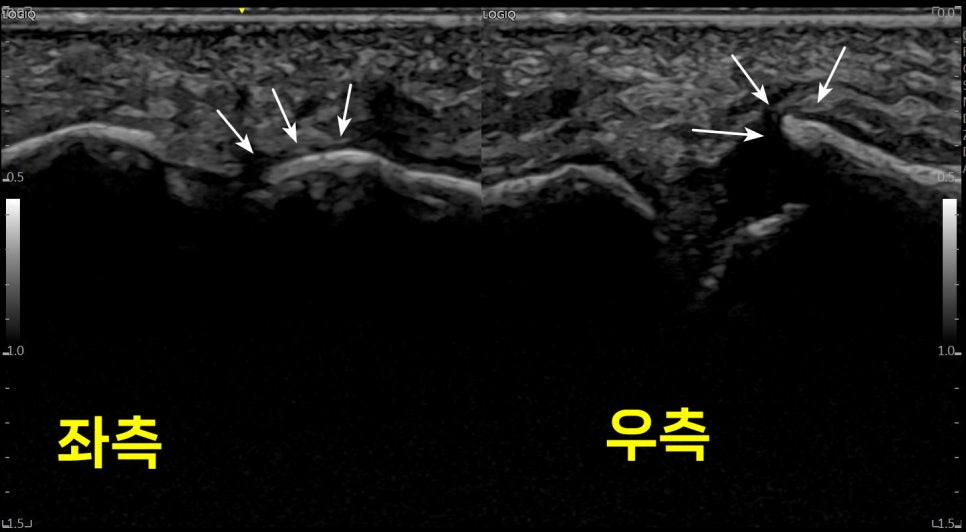 엄지발가락 관절의 좌우 초음파 비교 사진으로, 우측 관절의 골절 부위를 화살표로 표시합니다 — 초음파 정밀 진단 | 서울 바로한의원 초음파 약침·도침·침도