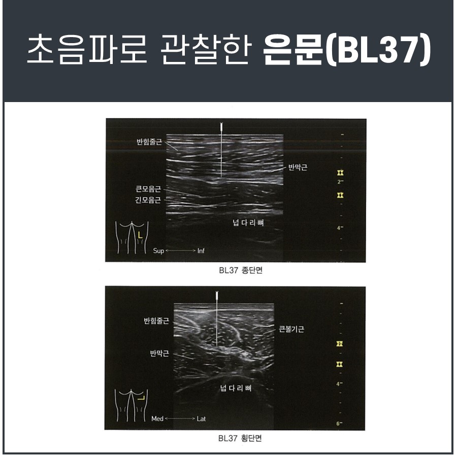 BL37 혈자리 주변의 햄스트링 근육과 넙다리뼈를 초음파로 관찰한 종단면 및 횡단면 이미지 — 초음파 정밀 진단 | 서울 바로한의원 초음파 약침·도침·침도