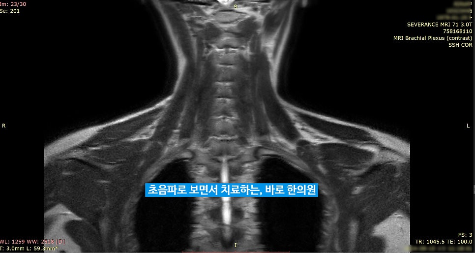 목과 어깨 부위의 상완신경총 MRI 영상입니다 — 서울 바로한의원 초음파 약침·도침