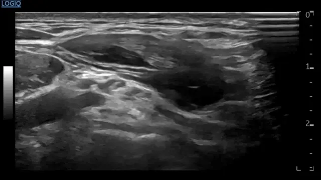 상완신경총 주변 조직을 보여주는 초음파 영상 — 초음파 정밀 진단 | 서울 바로한의원 초음파 약침·도침·침도