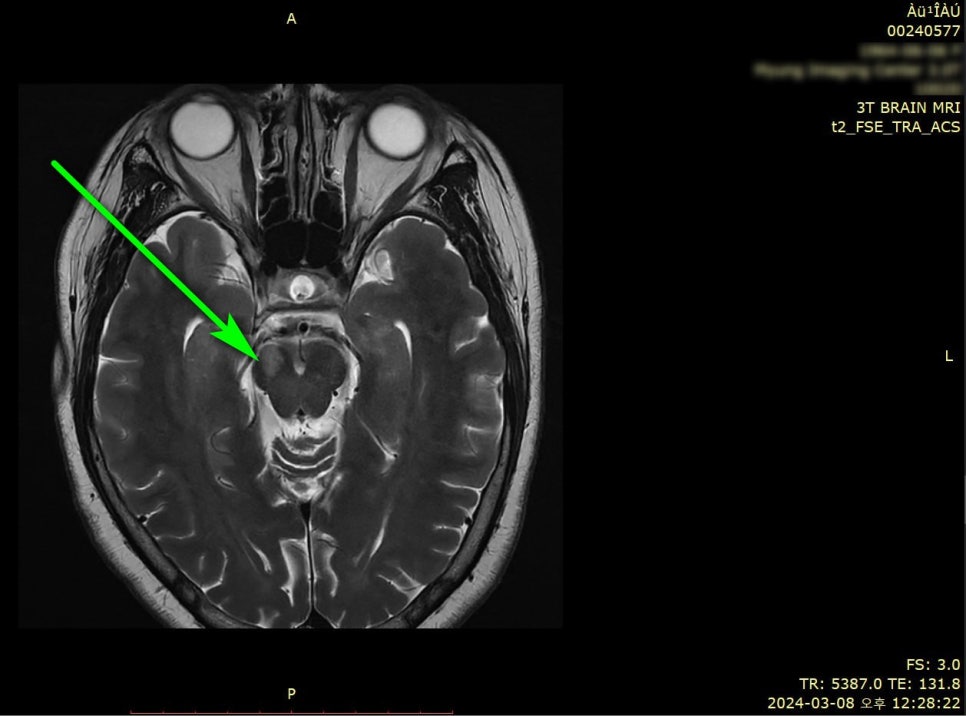 뇌 MRI 영상에서 녹색 화살표가 뇌간 부위를 가리키고 있다 — 서울 바로한의원 초음파 약침·도침