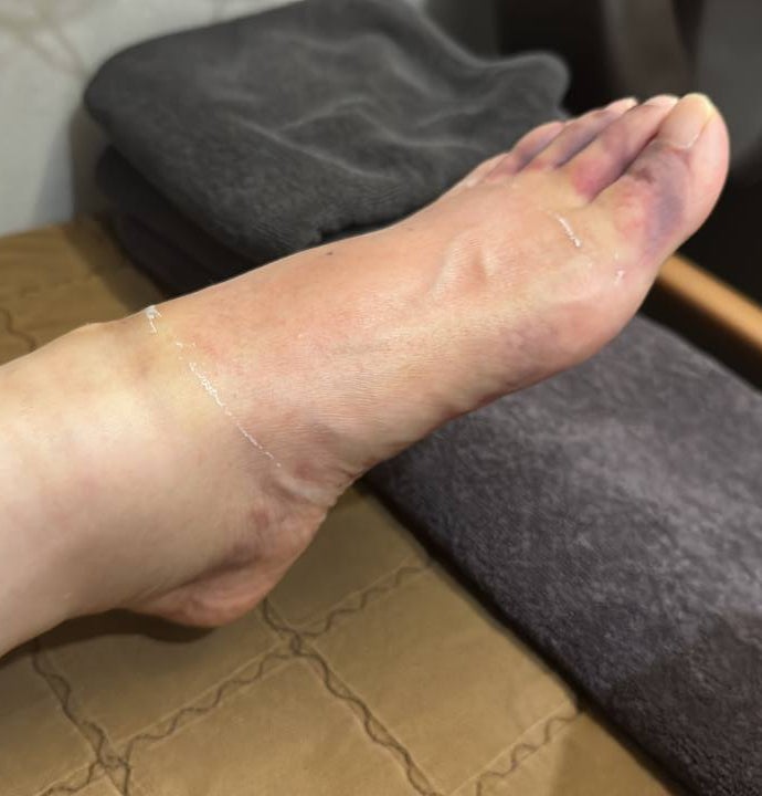발등과 발가락에 붓기와 보라색 멍이 있는 발 사진 — 서울 바로한의원 초음파 약침·도침