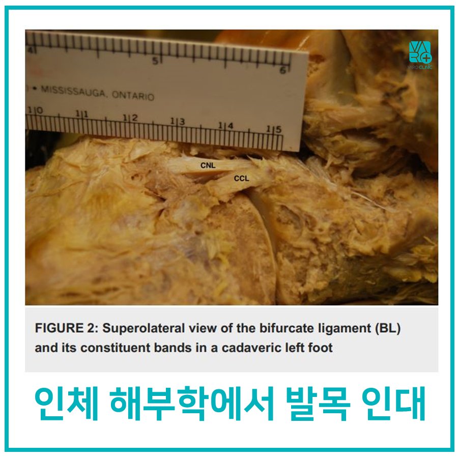 해부된 인체 발목의 이분인대와 주변 조직을 보여주는 사진 — 서울 바로한의원 초음파 약침·도침