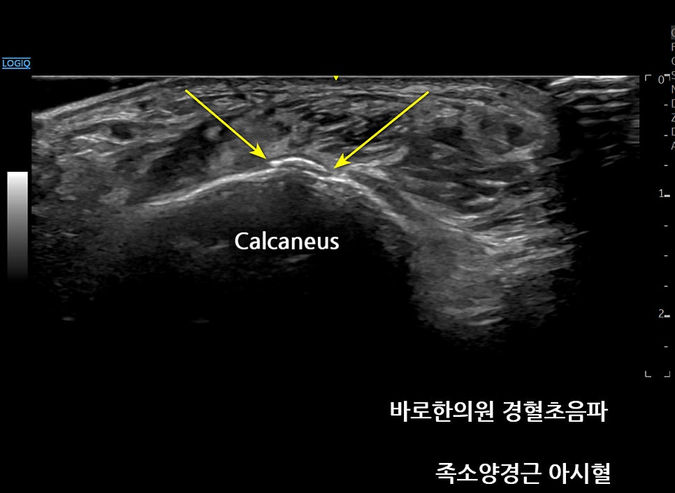 발목 종골 골절, 발등 미세골절이 X-RAY에서 안 보이나요?