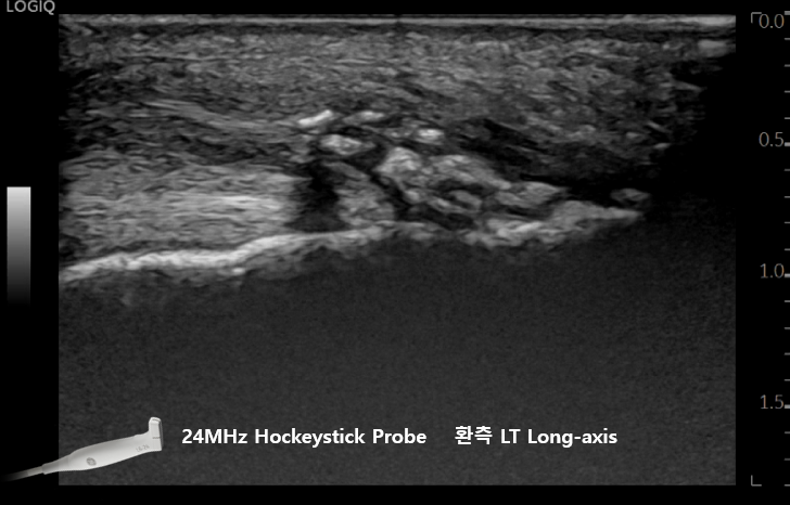 건에 석회가 침착된 초음파 사진 — 초음파 정밀 진단 | 서울 바로한의원 초음파 약침·도침·침도