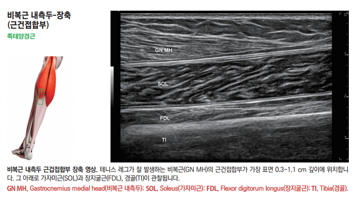 종아리 근육 해부도와 비복근 내측두, 가자미근, 장지굴근, 경골이 표시된 종아리 초음파 영상 — 초음파 정밀 진단 | 서울 바로한의원 초음파 약침·도침·침도