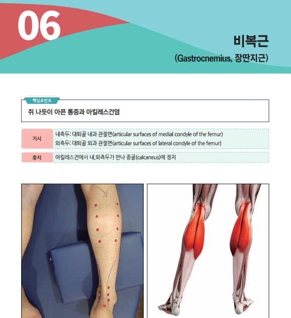사람 다리에 표시된 종아리 통증점과 비복근 해부학 그림 — 서울 바로한의원 초음파 약침·도침