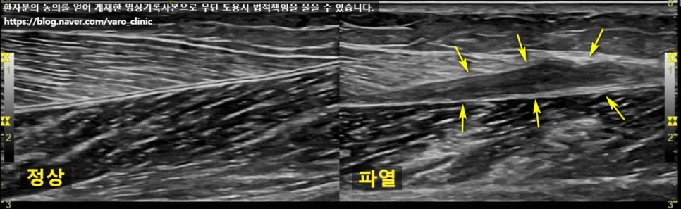 정상 종아리 근육과 파열된 종아리 근육을 보여주는 초음파 사진 — 초음파 정밀 진단 | 서울 바로한의원 초음파 약침·도침·침도