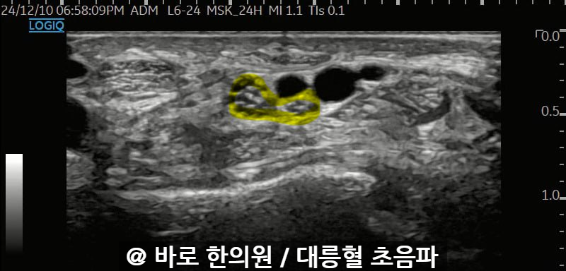 손목 부위의 초음파 사진으로, 노란색으로 표시된 신경이 관찰된다 — 초음파 정밀 진단 | 서울 바로한의원 초음파 약침·도침·침도