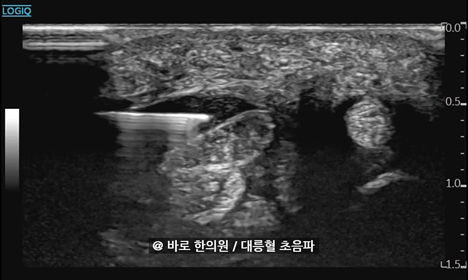 대릉혈 부위에 침이 삽입된 초음파 영상 — 초음파 정밀 진단 | 서울 바로한의원 초음파 약침·도침·침도
