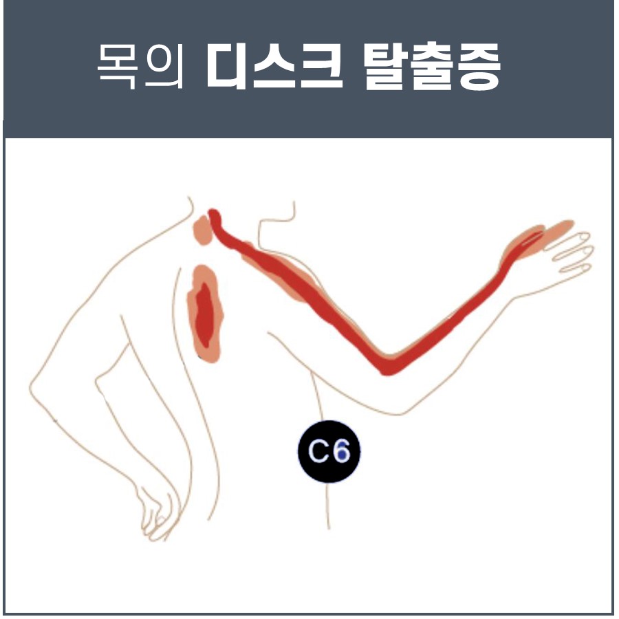 목 디스크 증상, 치료? 한의원에서 치료해야 하는 이유